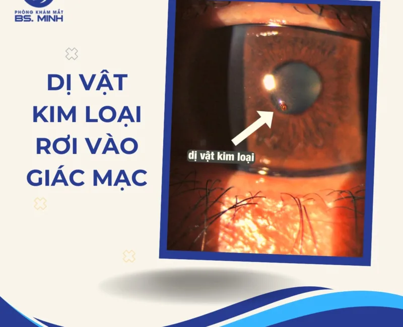 Lấy dị vật mắt Bến Tre phòng khám mắt THs.bs.ck2 Lữ Bảo Minh