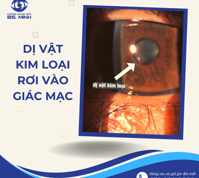 Lấy dị vật mắt Bến Tre phòng khám mắt THs.bs.ck2 Lữ Bảo Minh