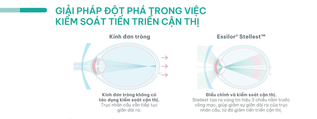 Giải pháp kiểm soát tiến triển cận thị bằng tròng kính