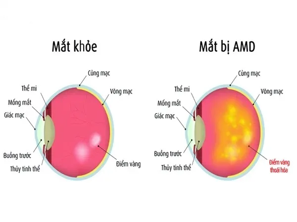Thoái hóa hoàng điểm và ảnh hưởng của ánh sáng xanh đến võng mạc