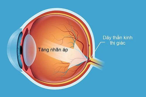 Tăng nhãn áp có thể được phát hiện qua kiểm tra mắt định kỳ