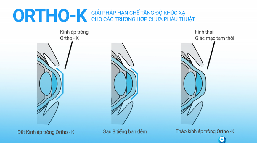 Ortho-K trong điều trị tật khúc xạ không phẫu thuật