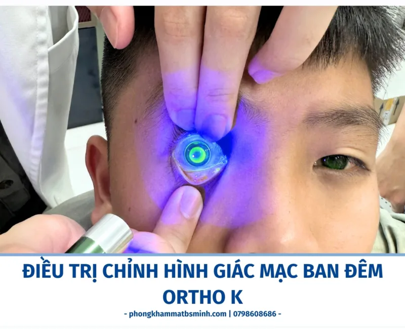 Điều trị chỉnh hình giác mạc ban đêm Ortho K