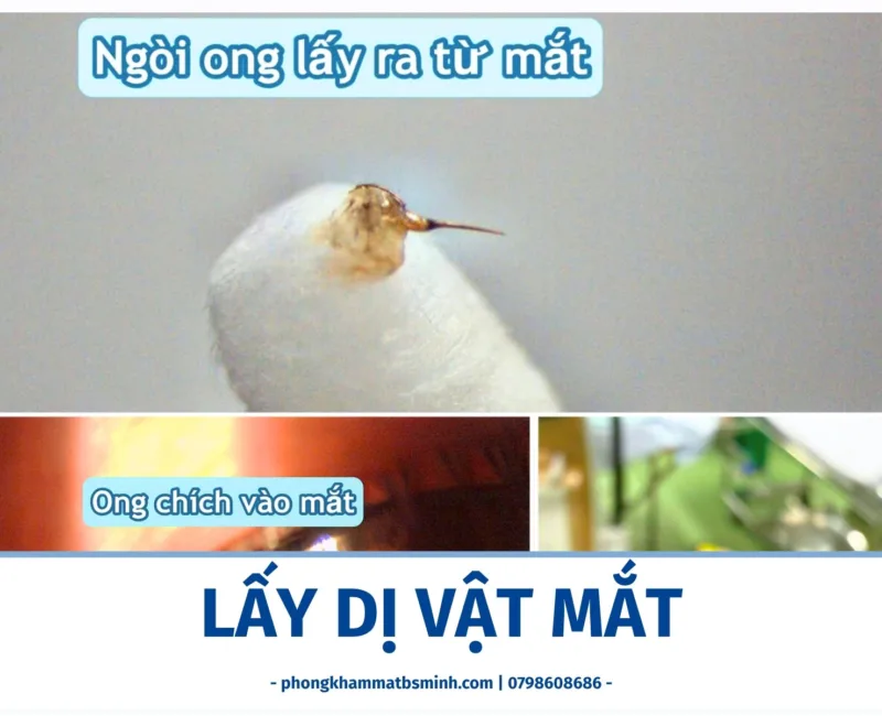 Lấy dị vật mắt