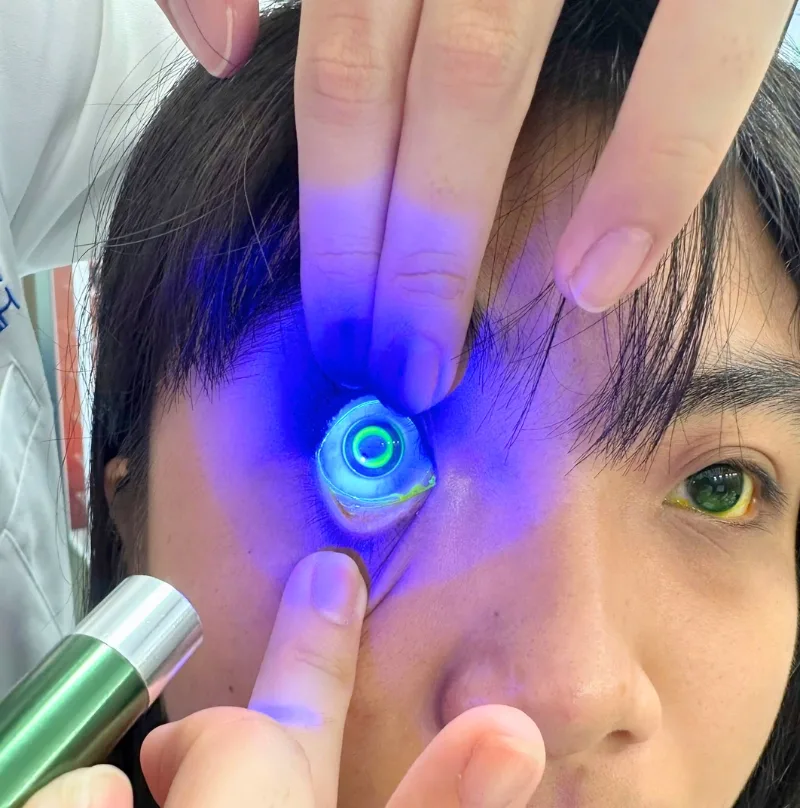 Kính ortho K chỉnh hình giác mạc ban đêm tại Bến Tre