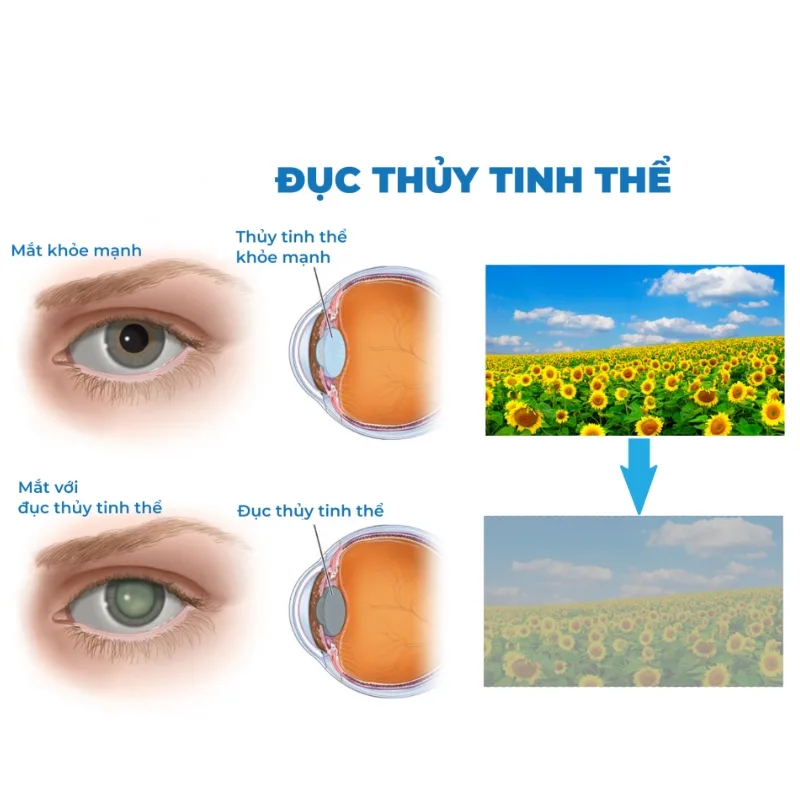 Mổ cườm khô tại Bến Tre - minh họa thủy tinh thể bị đục