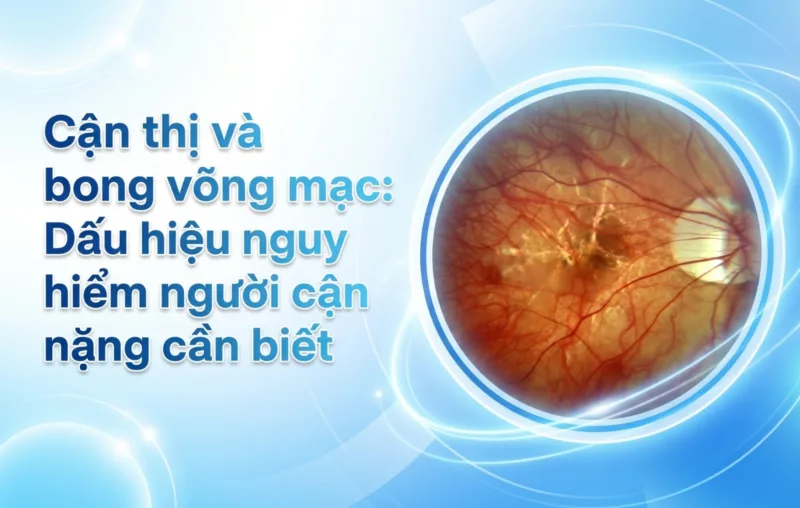 can thi va bong vong mac