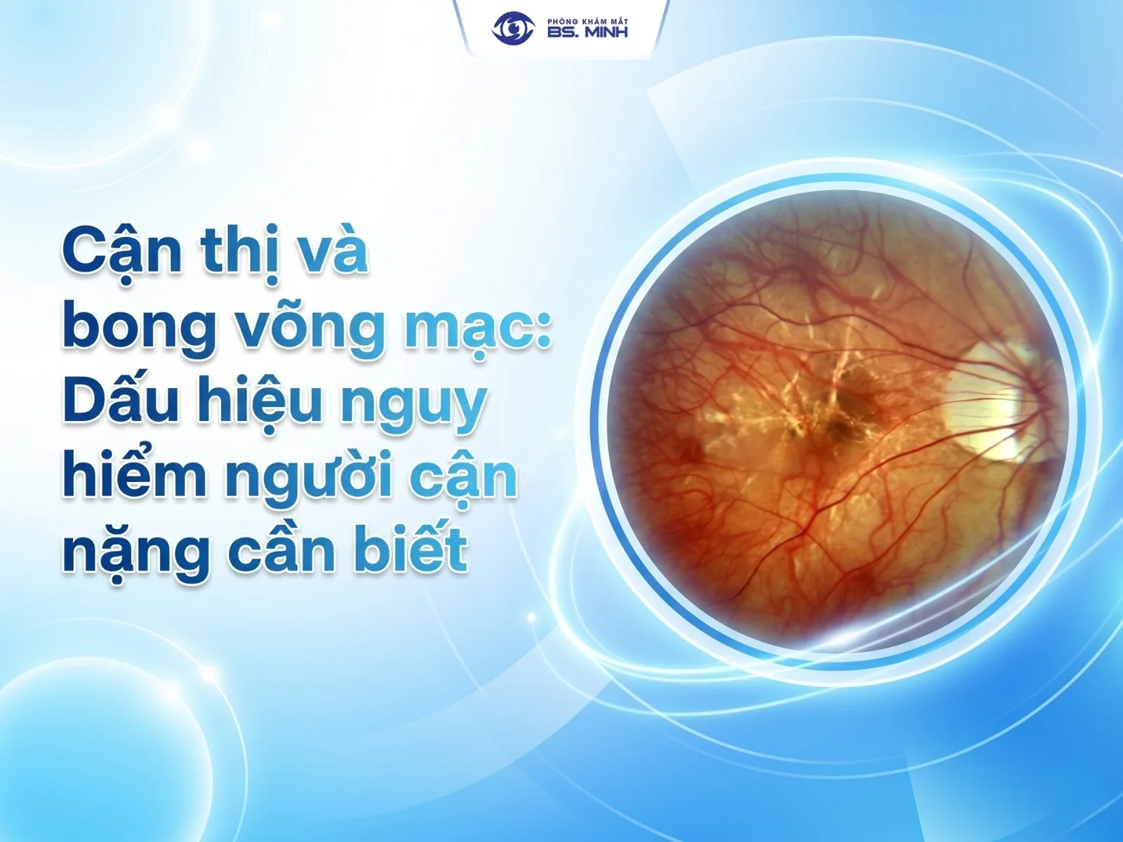 can thi va bong vong mac