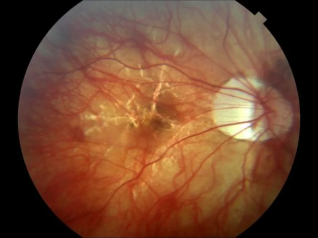 can thi cao co nguy hiem khong