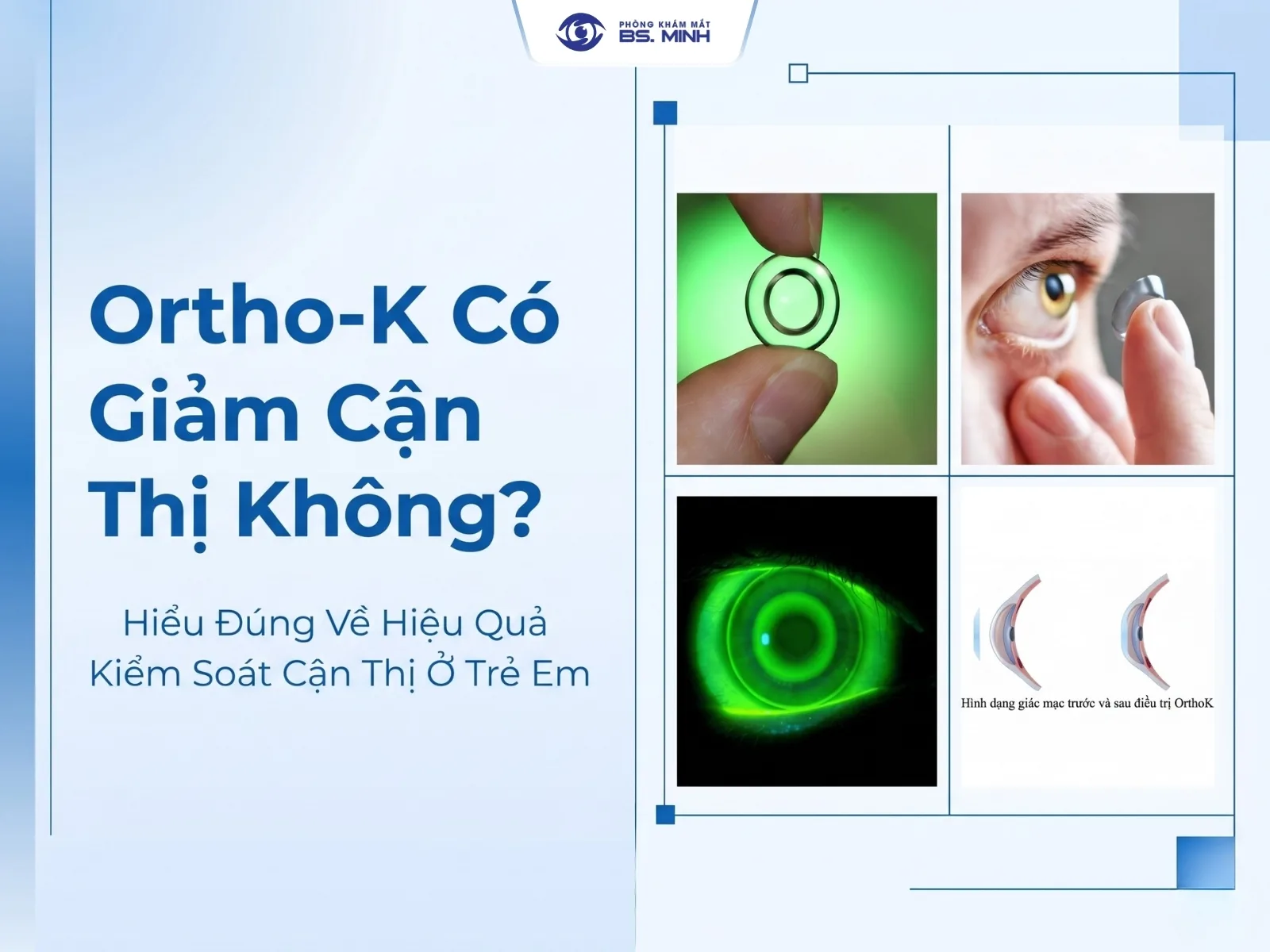 ortho-k co giam can thi khong