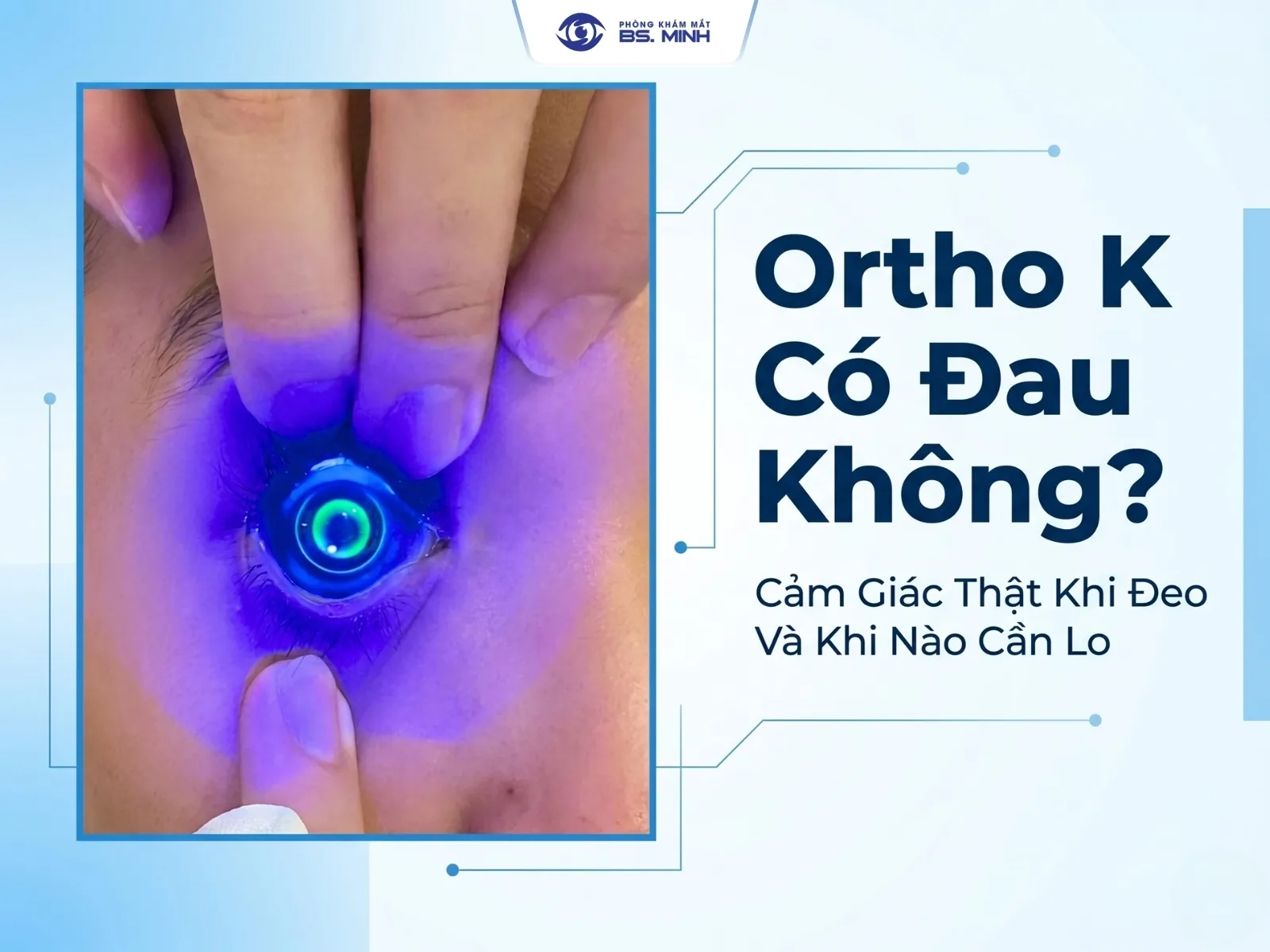 ortho-k co dau khong