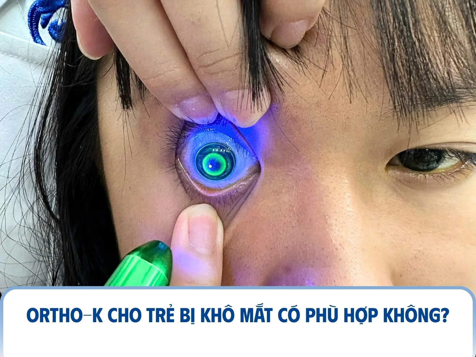 Ortho-K cho trẻ bị khô mắt có phù hợp không?