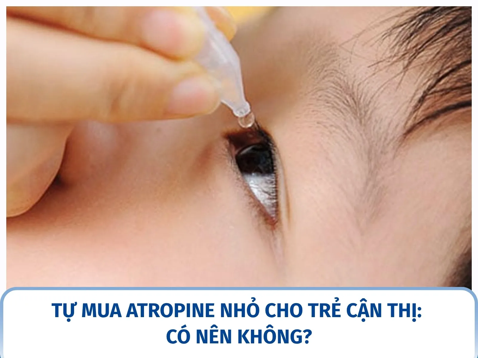 Tự mua Atropine nhỏ cho trẻ cận thị: có nên không?