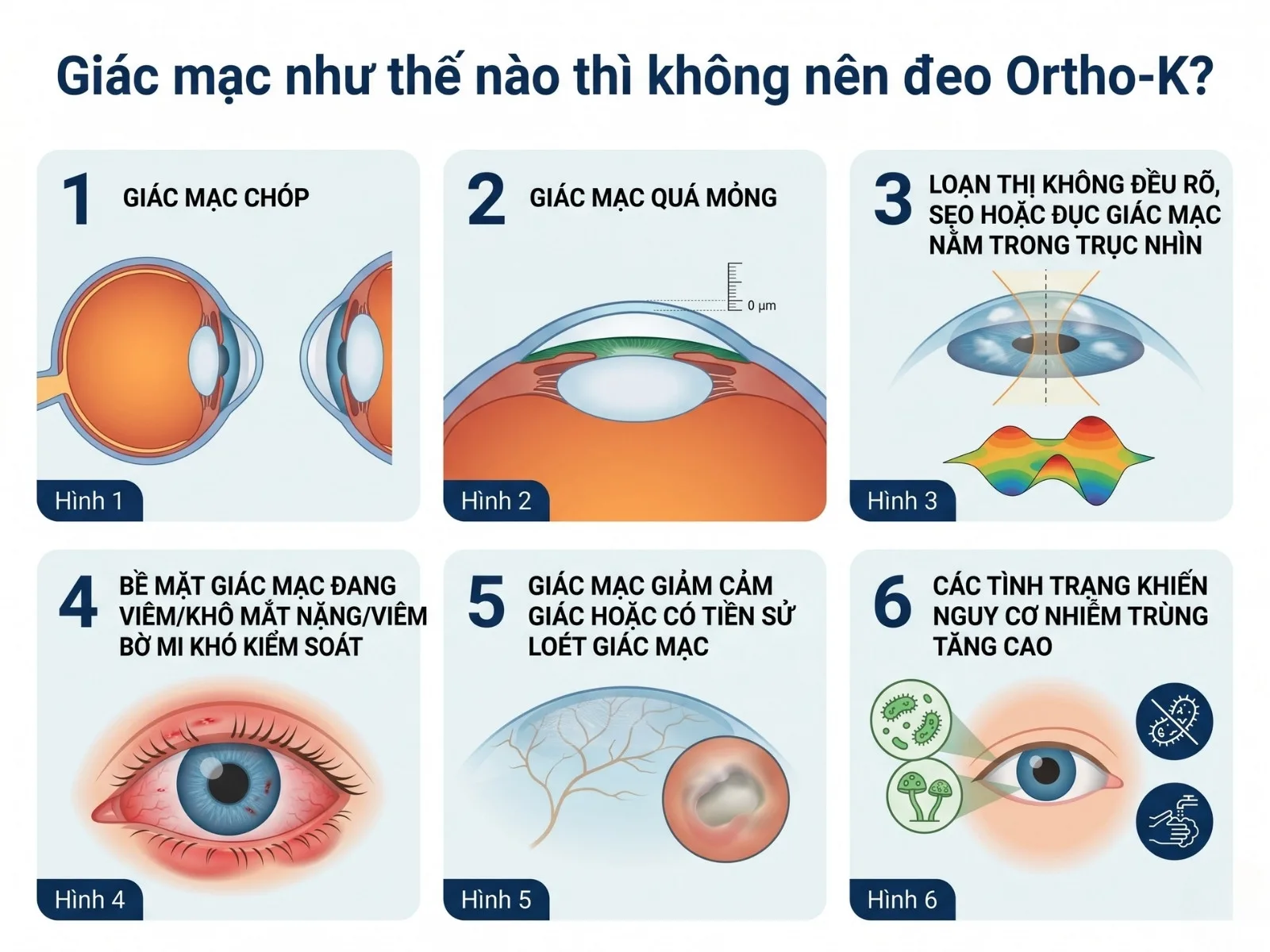 Giác mạc như thế nào thì không nên đeo Ortho-K?