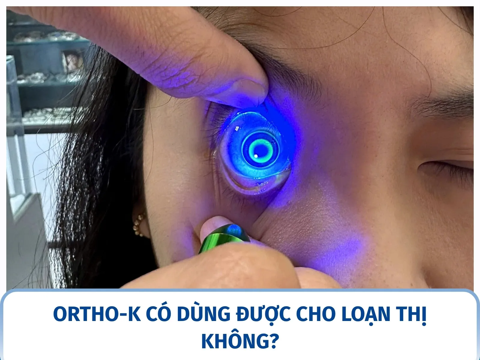 Ortho-K có dùng được cho loạn thị không?
