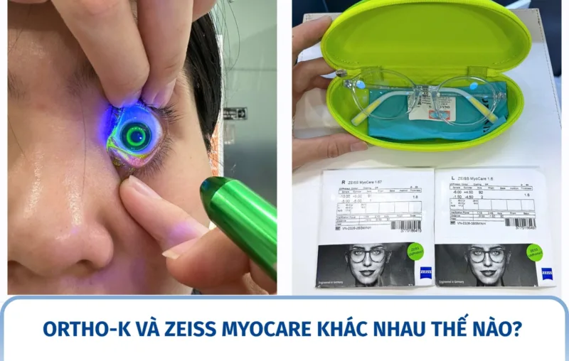 Ortho-K và ZEISS MyoCare khác nhau thế nào?