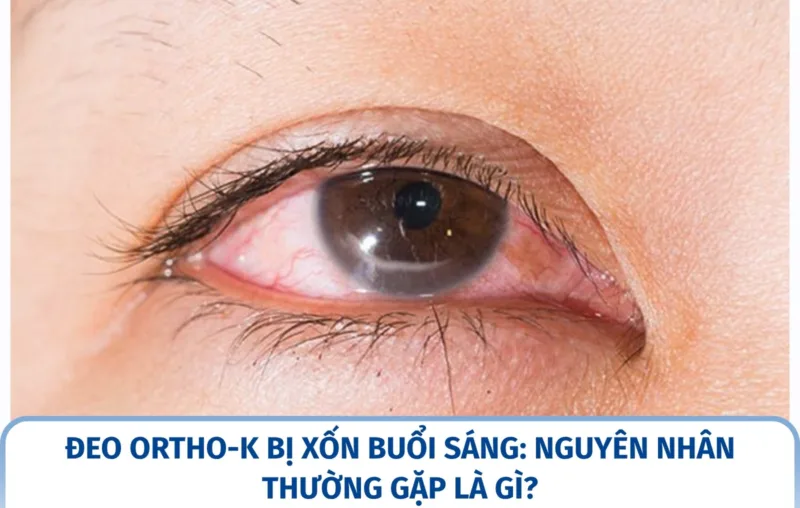 Đeo Ortho-K bị xốn buổi sáng: nguyên nhân thường gặp là gì?