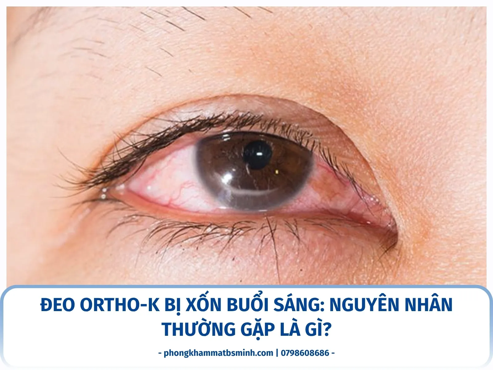 Đeo Ortho-K bị xốn buổi sáng: nguyên nhân thường gặp là gì?
