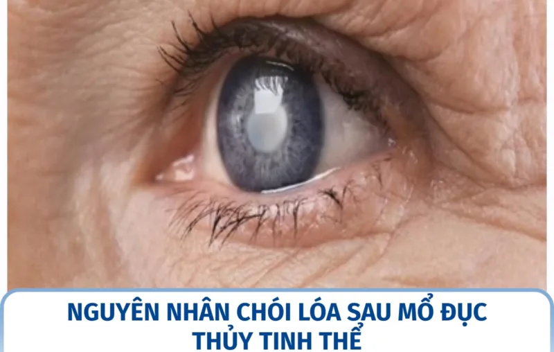 Nguyên nhân chói lóa sau mổ đục thủy tinh thể