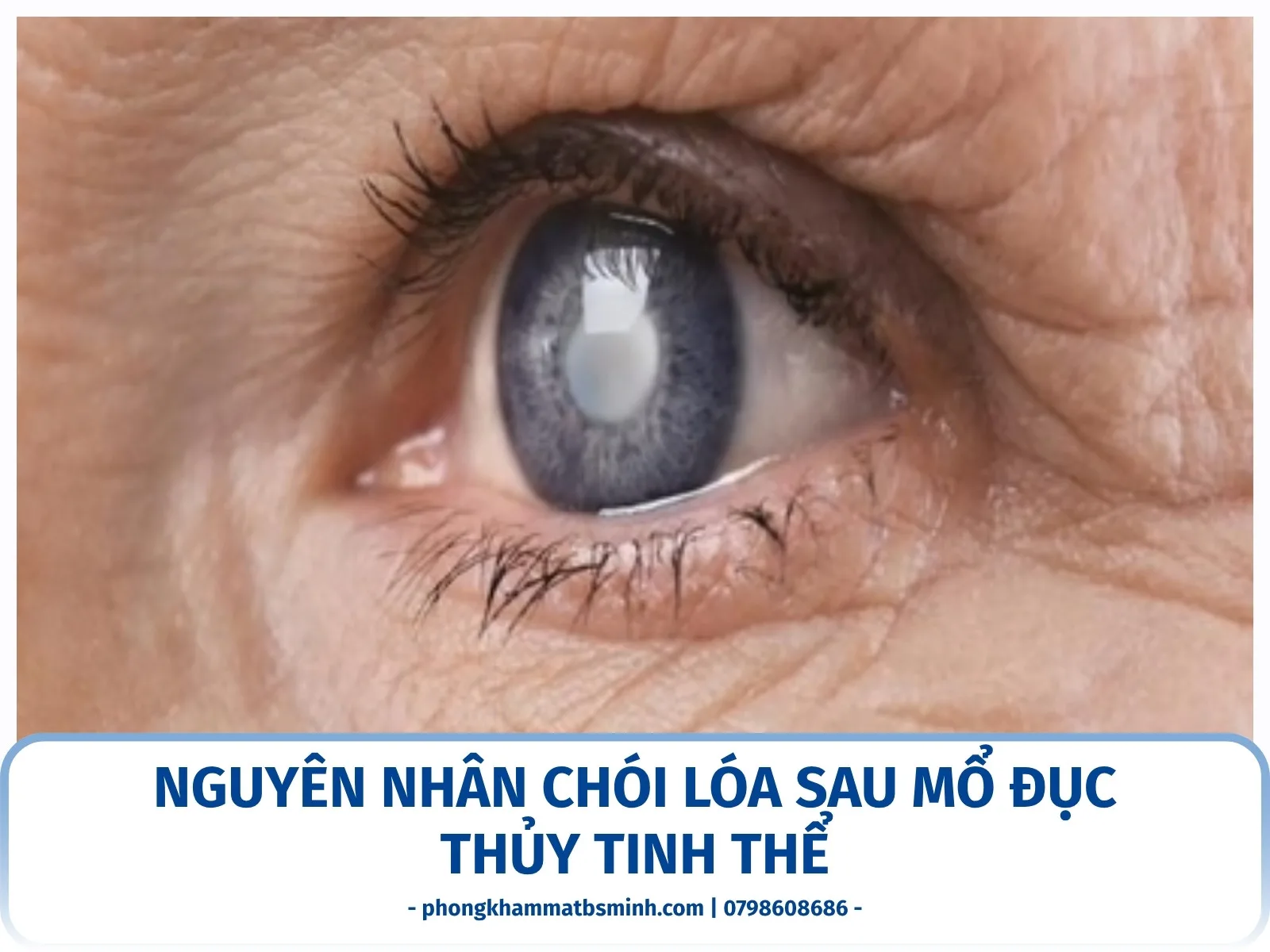 Nguyên nhân chói lóa sau mổ đục thủy tinh thể