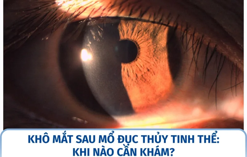 Khô mắt sau mổ đục thủy tinh thể: khi nào cần khám?