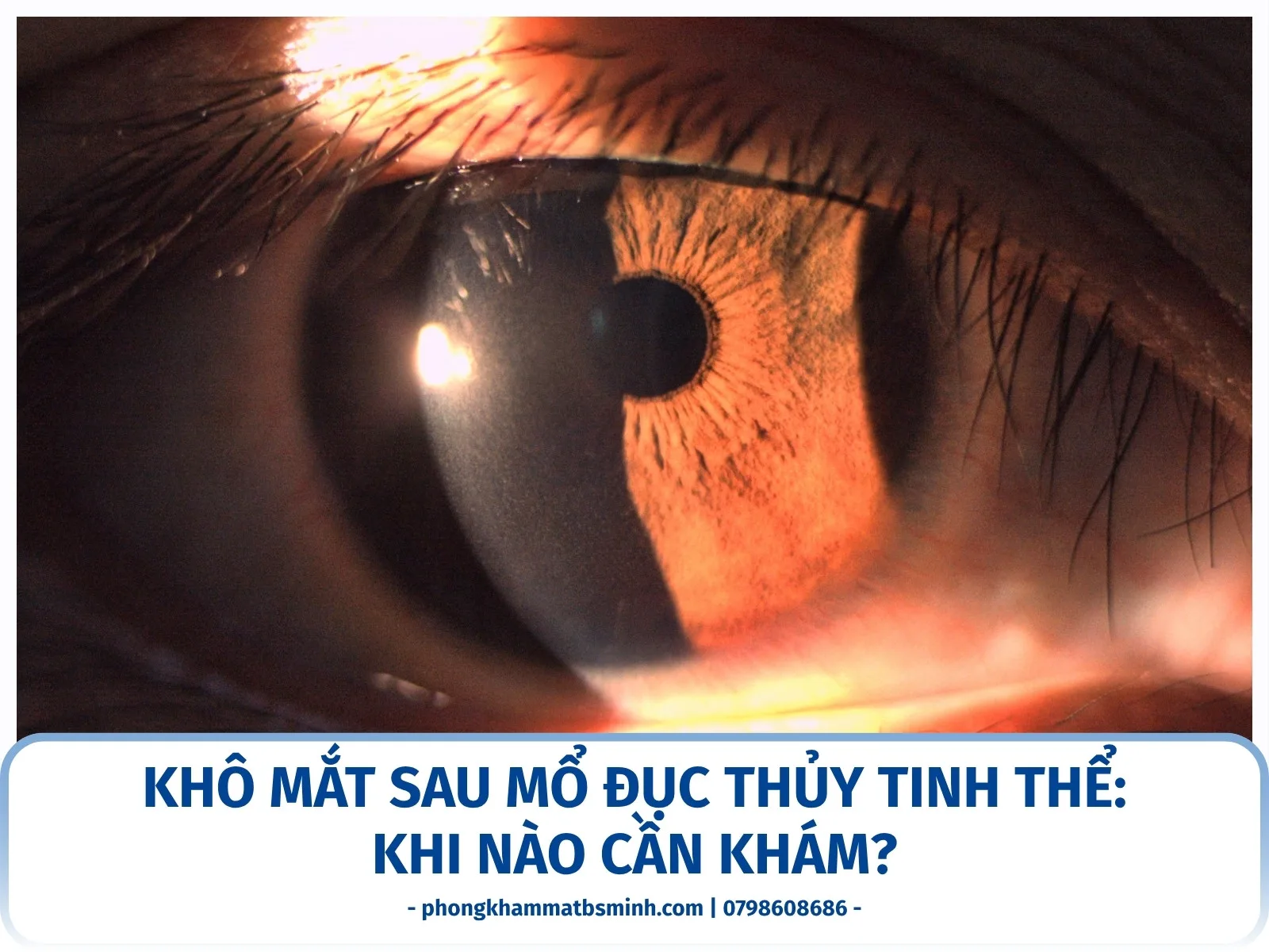 Khô mắt sau mổ đục thủy tinh thể: khi nào cần khám?