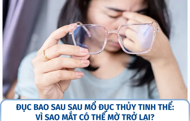 Đục bao sau sau mổ đục thủy tinh thể: vì sao mắt có thể mờ trở lại?