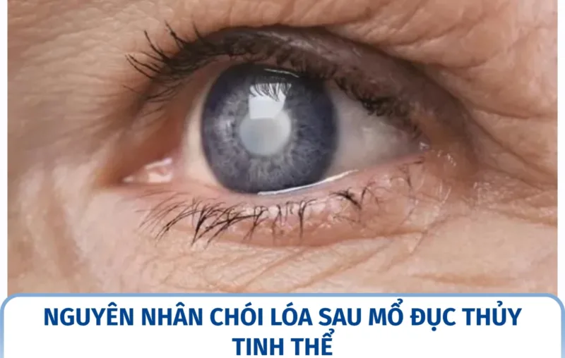 Nguyên nhân chói lóa sau mổ đục thủy tinh thể