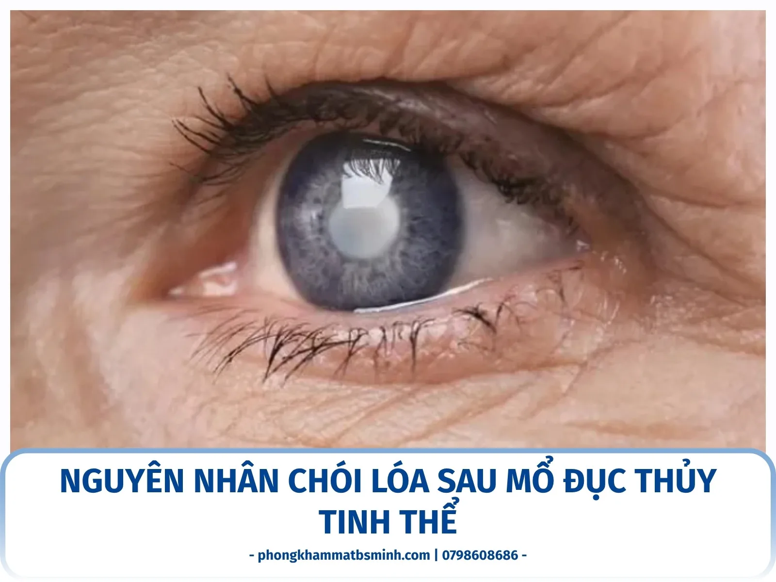 Nguyên nhân chói lóa sau mổ đục thủy tinh thể