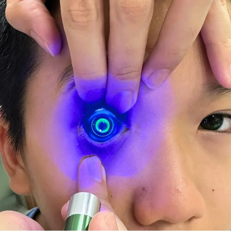Ortho K tại Bến Tre cho trẻ cận thị