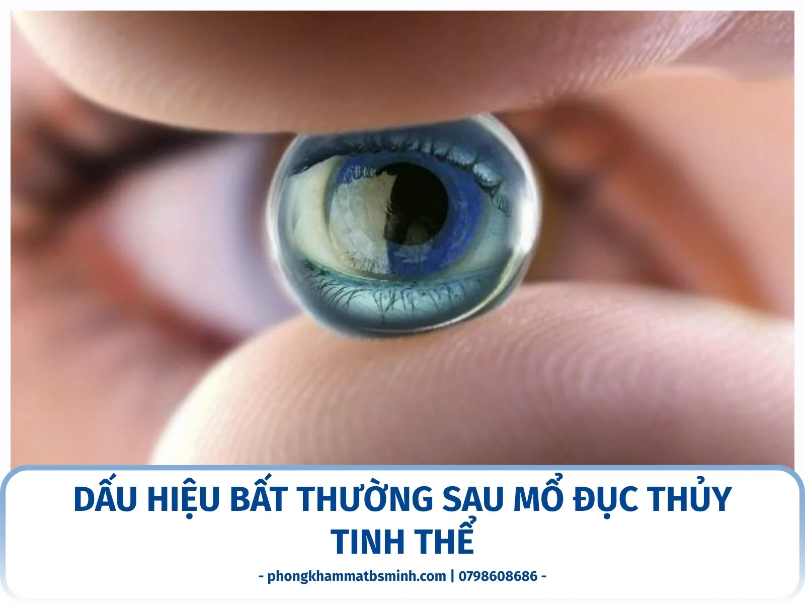 Dấu hiệu bất thường sau mổ đục thủy tinh thể