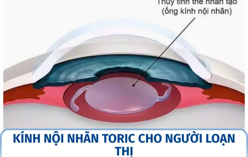 Kính nội nhãn Toric cho người loạn thị