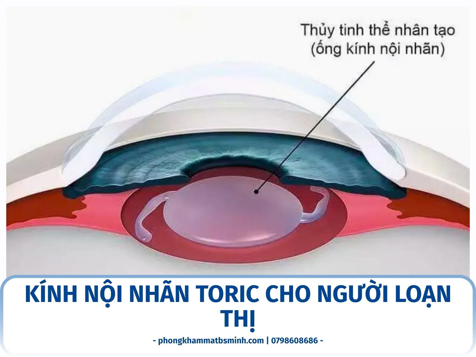 Kính nội nhãn Toric cho người loạn thị