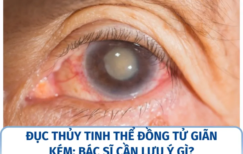 Đục thủy tinh thể đồng tử giãn kém: bác sĩ cần lưu ý gì?