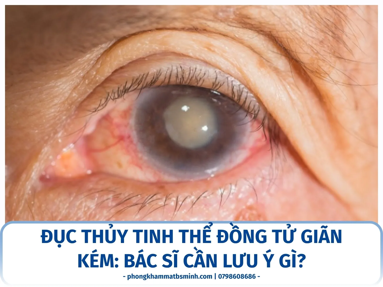 Đục thủy tinh thể đồng tử giãn kém: bác sĩ cần lưu ý gì?