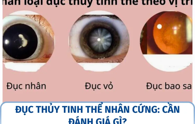 Đục thủy tinh thể nhân cứng: cần đánh giá gì?