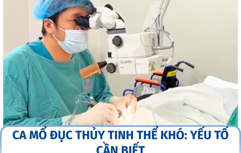 Ca mổ đục thủy tinh thể khó: yếu tố cần biết