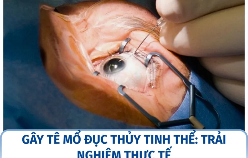 Gây tê mổ đục thủy tinh thể: trải nghiệm thực tế