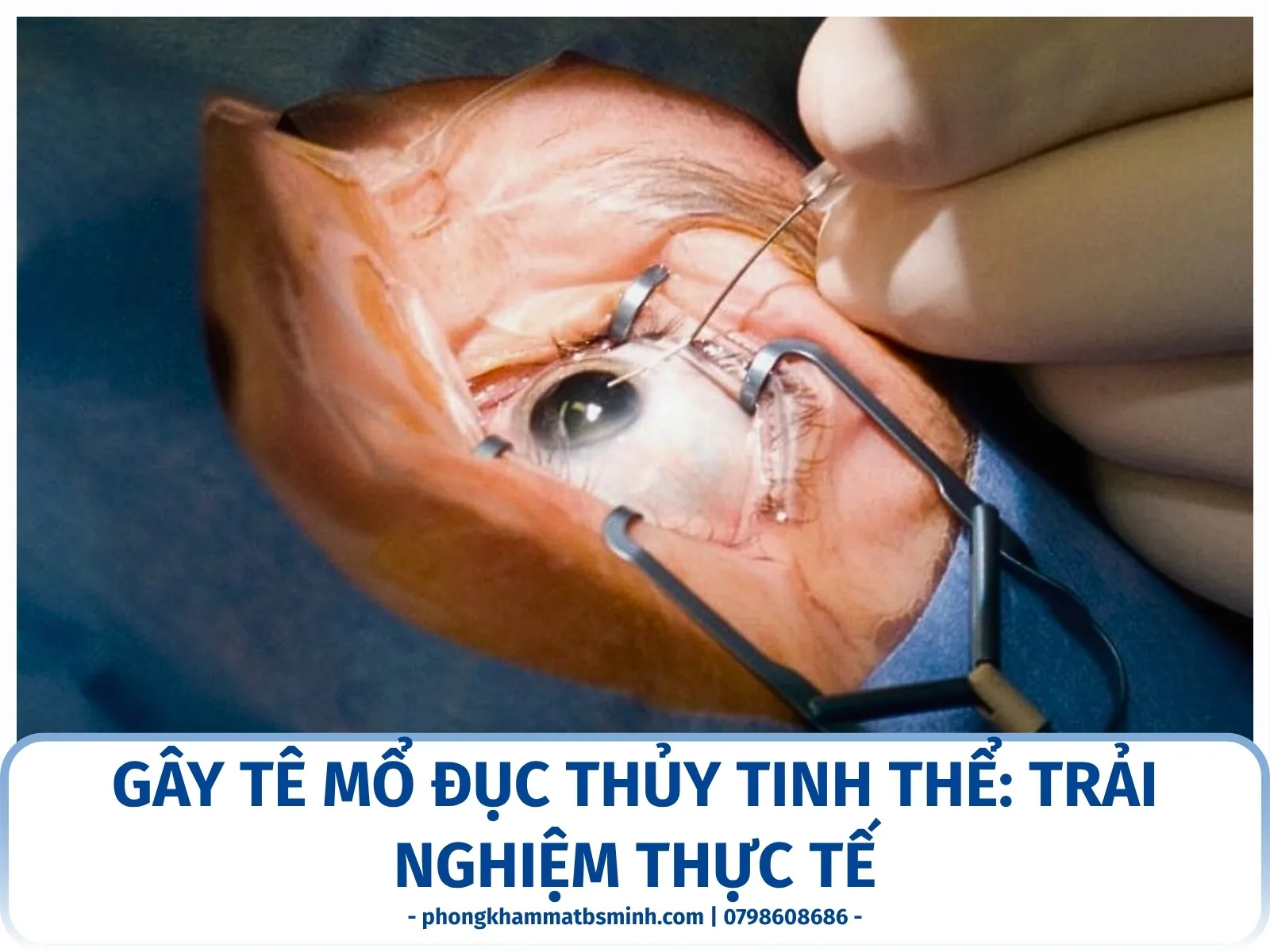 Gây tê mổ đục thủy tinh thể: trải nghiệm thực tế