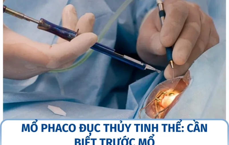 Mổ phaco đục thủy tinh thể: cần biết trước mổ