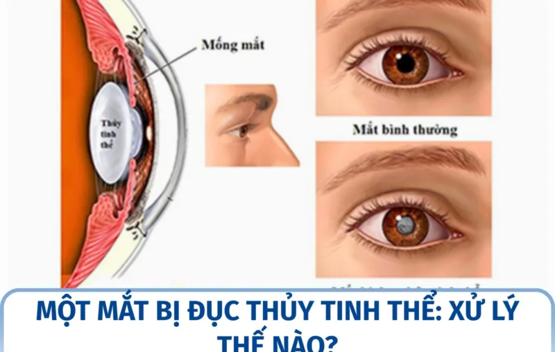 Một mắt bị đục thủy tinh thể: xử lý thế nào?