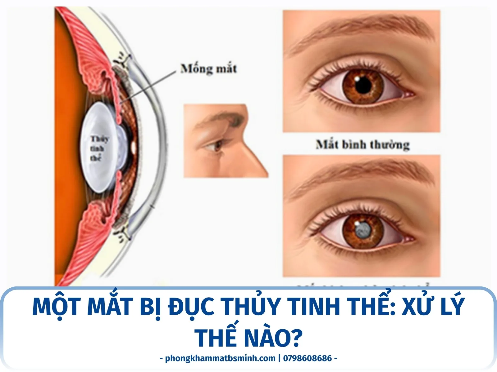 Một mắt bị đục thủy tinh thể: xử lý thế nào?