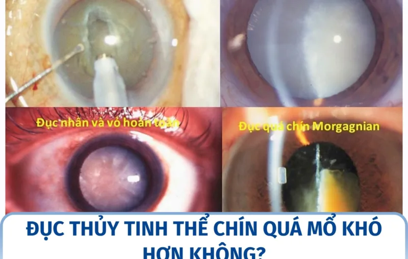Đục thủy tinh thể chín quá mổ khó hơn không?