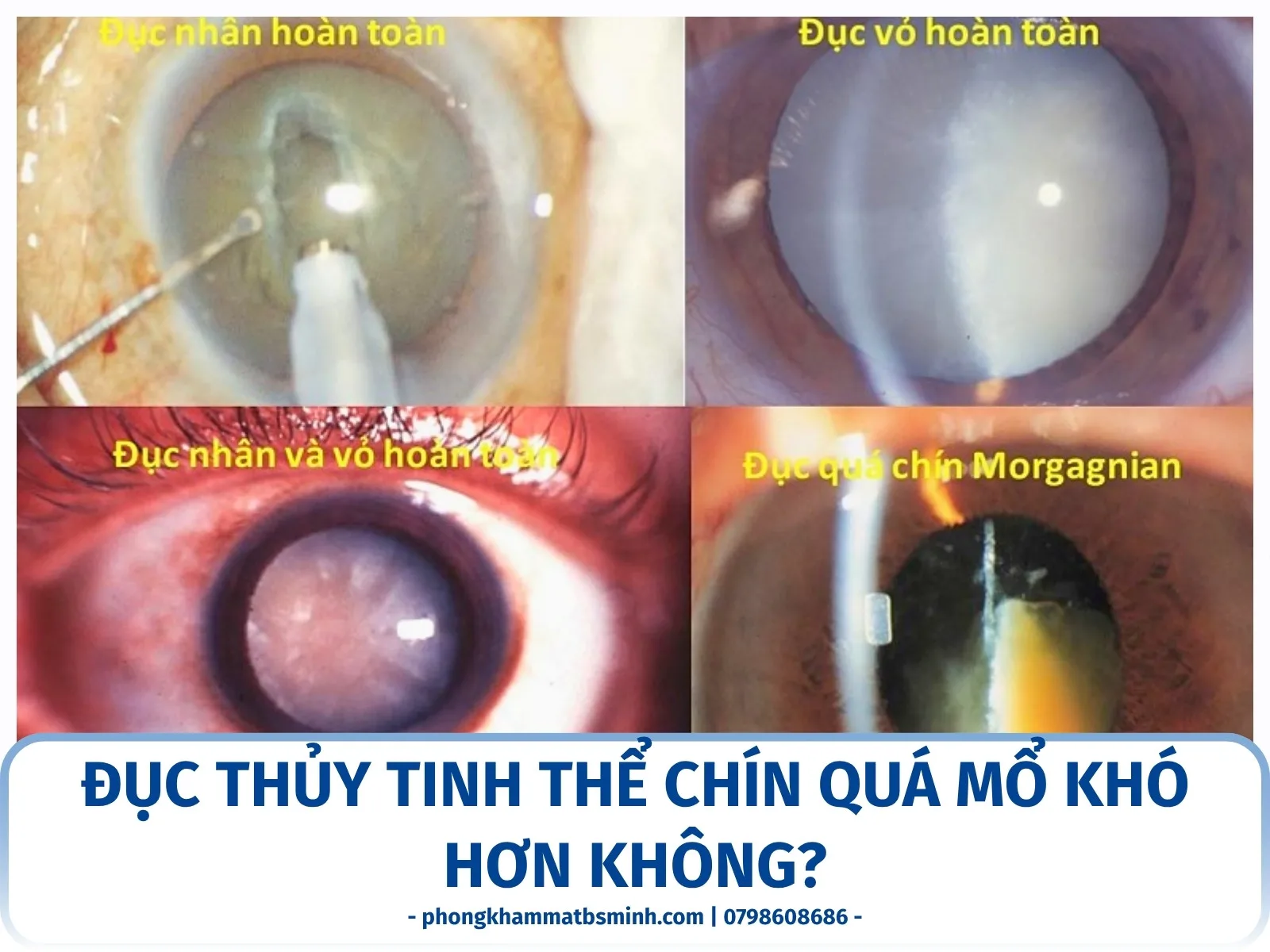 Đục thủy tinh thể chín quá mổ khó hơn không?
