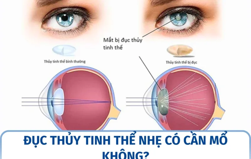 Đục thủy tinh thể nhẹ có cần mổ không?