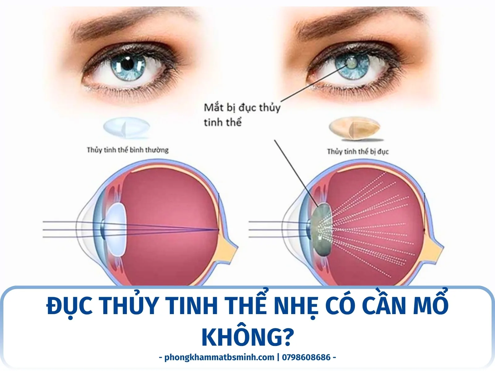 Đục thủy tinh thể nhẹ có cần mổ không?