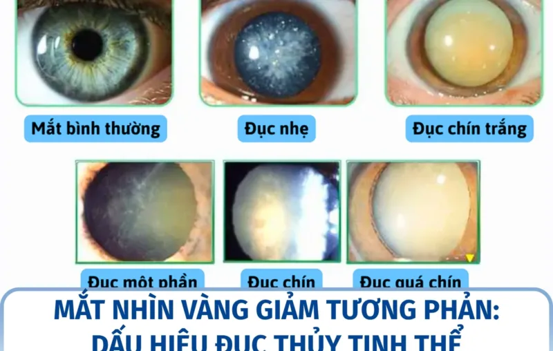 Mắt nhìn vàng giảm tương phản: dấu hiệu đục thủy tinh thể