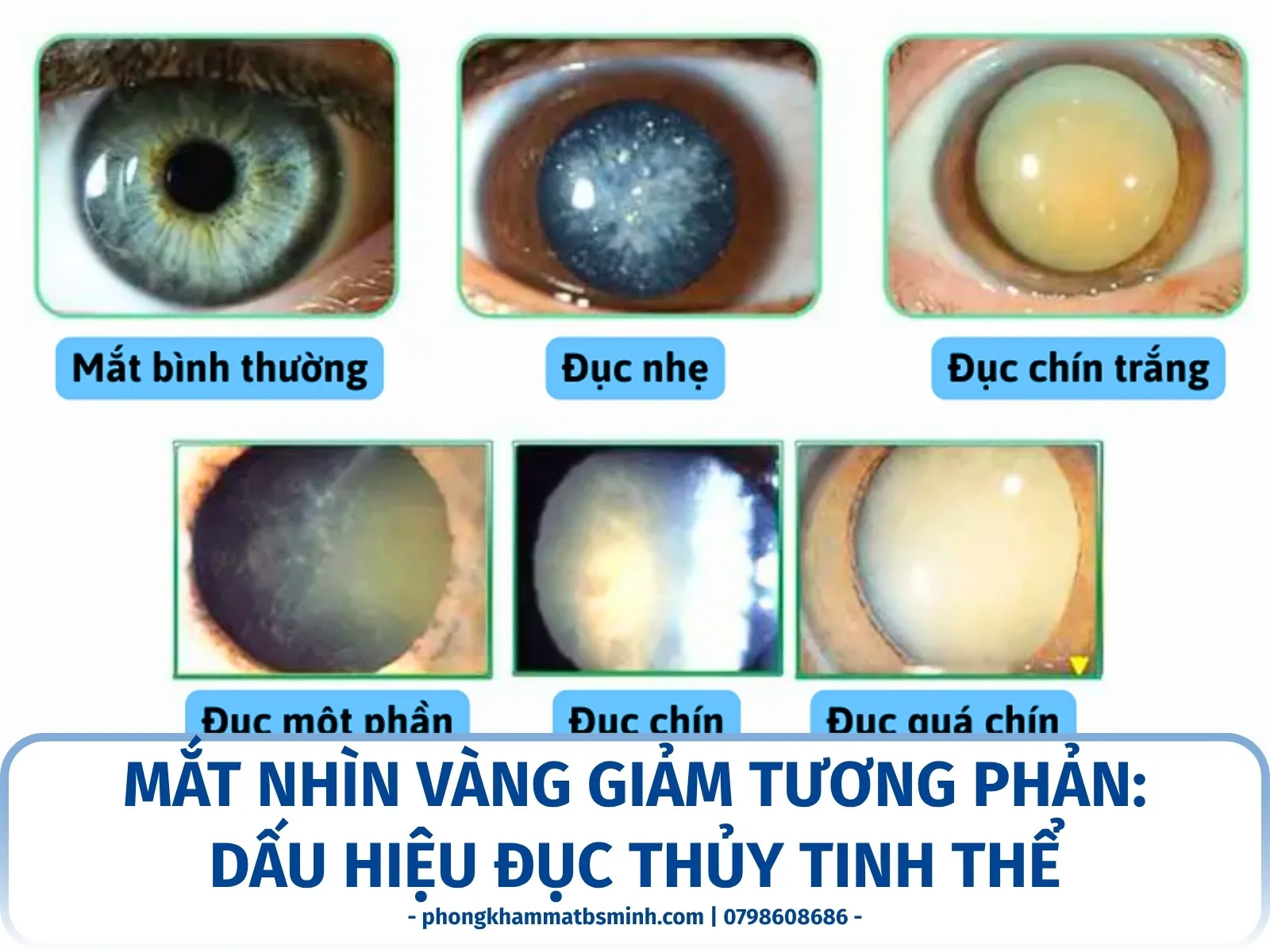 Mắt nhìn vàng giảm tương phản: dấu hiệu đục thủy tinh thể