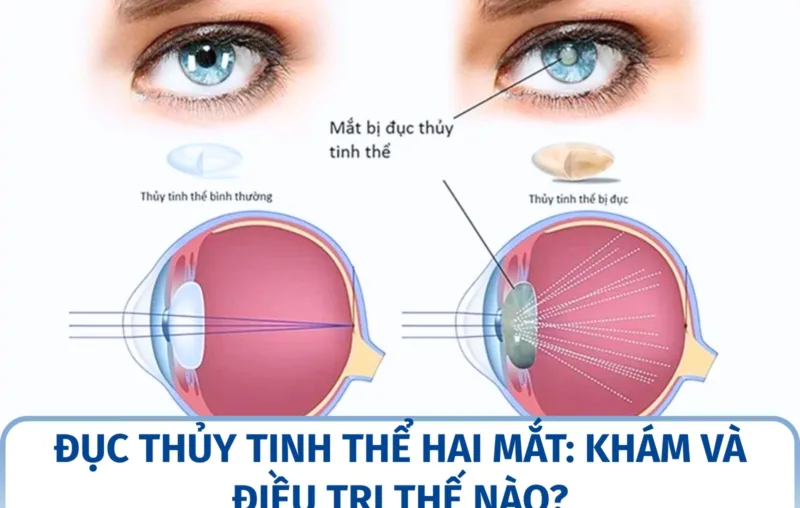 Đục thủy tinh thể hai mắt: khám và điều trị thế nào?