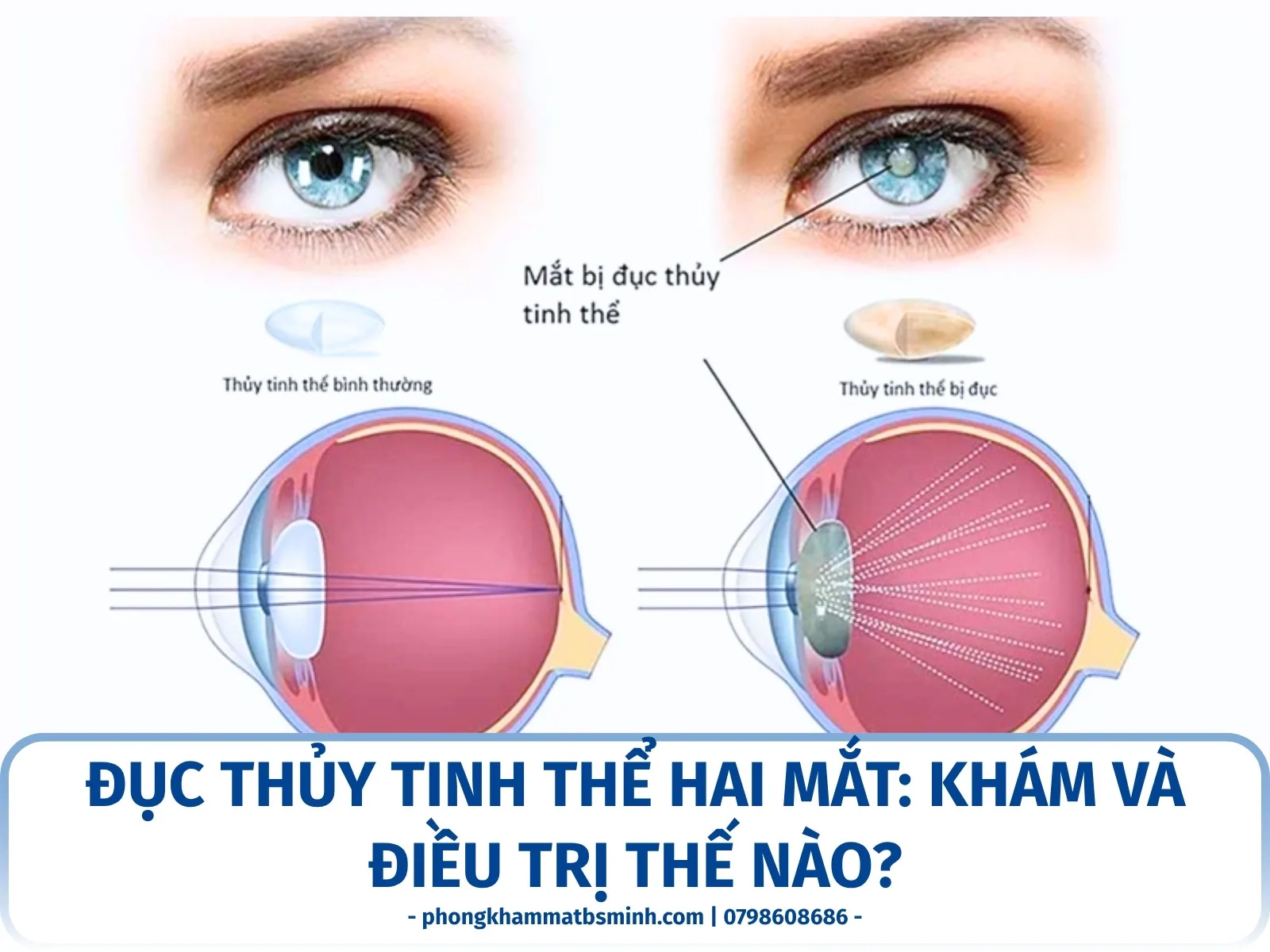 Đục thủy tinh thể hai mắt: khám và điều trị thế nào?